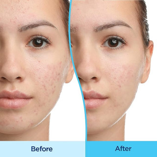 Differin Adapalene Gel 0.1% Acne Treatment 15g Differin Adapalene Gel 0.1% Acne Treatment 15g